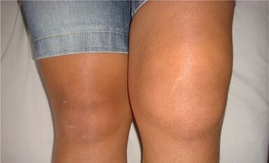The causes of the osteoarthritis of the knee joint