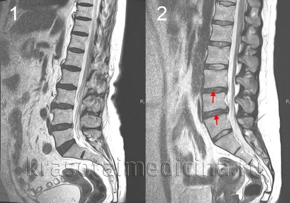 Column osteochondrosis