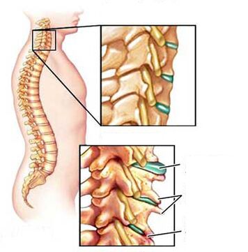 Comparison of a healthy and sick vertebra in the neck