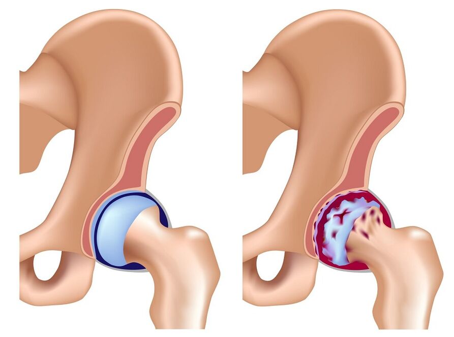 healthy joint and osteoarthritis of the hip joint